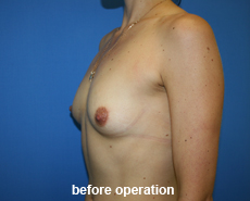 plastic-surgery-breast-augmentation